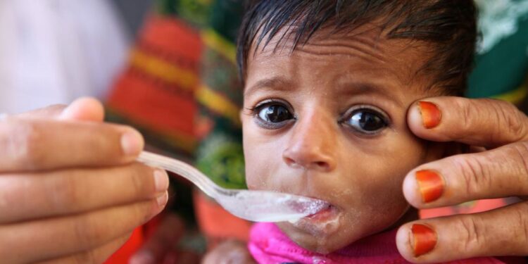 Une explosion catastrophique des taux de malnutrition sévère chez les enfants menace le monde, selon l’UNICEF