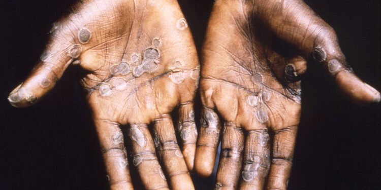 Variole du singe : l’OMS décidera la semaine prochaine si le virus représente une urgence sanitaire internationale