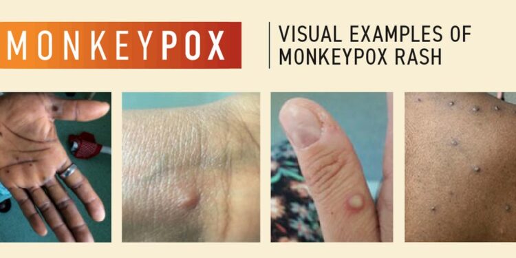 La variole du singe cause quatre décès hors d’Afrique, dont deux en Espagne – OMS