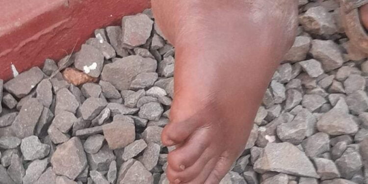 souffrant d’une fracture depuis à l’enfance Victime d’une fracture depuis à l’âge de 8 ans, Aïssata Sylla interpelle les personnes de bonne volonté pour lui sauver la vie.