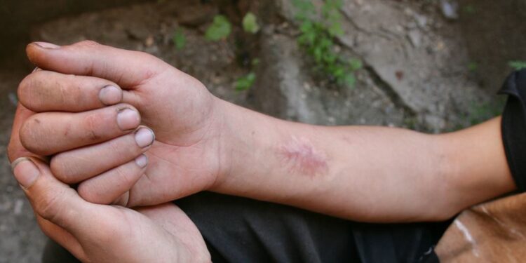 Drogues : l’ONU plaide pour une approche centrée sur les personnes pour lutter contre la stigmatisation