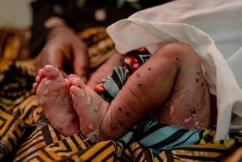 A Kinshasa, une campagne de vaccination contre le mpox cible 600.000 personnes