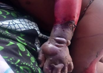 Boké-Société: 24 millions GNF pour sauver le bras d’un enfant victime d’une brûlure d’eau bouillante
