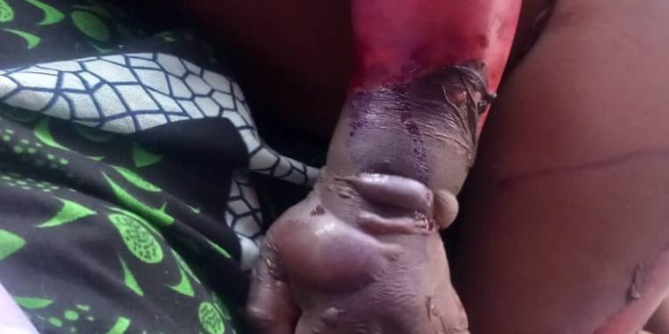 Boké-Société: 24 millions GNF pour sauver le bras d’un enfant victime d’une brûlure d’eau bouillante