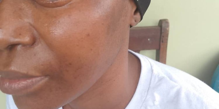 URGENT : S.O.S POUR DAME KADIATOU CAMARA, AGEE DE 39 ANS QUI SOUFFRE DE MENINGIOME DU JUGUM